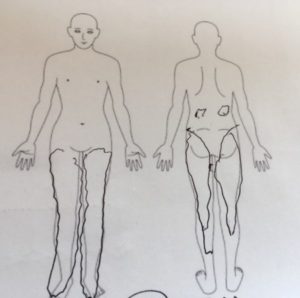 65歳 男性　MM様（富士見市）（坐骨神経痛）のカウンセリングシート